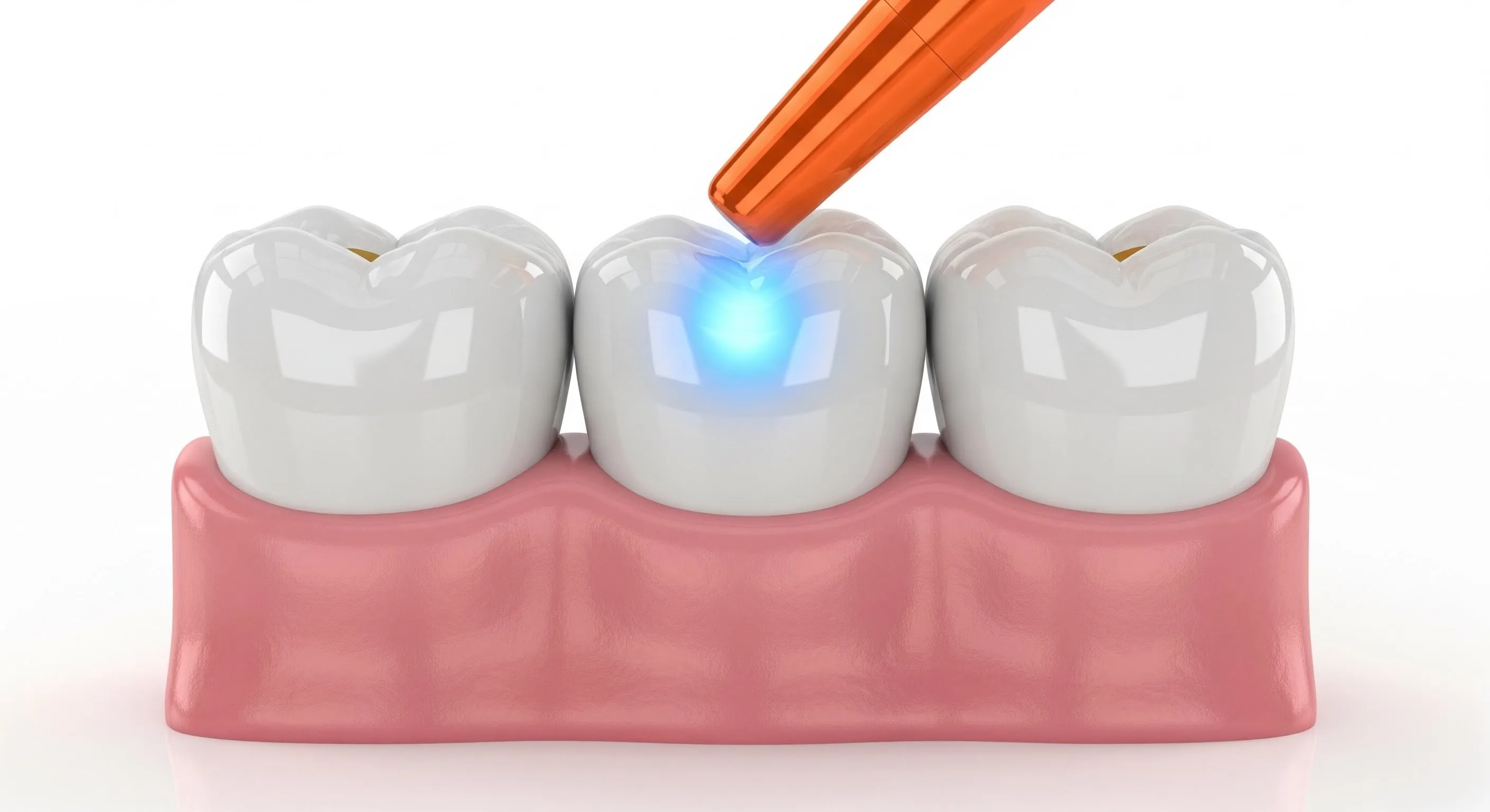 Composite Fillings Cost and Pricing Information in Lawrenceville